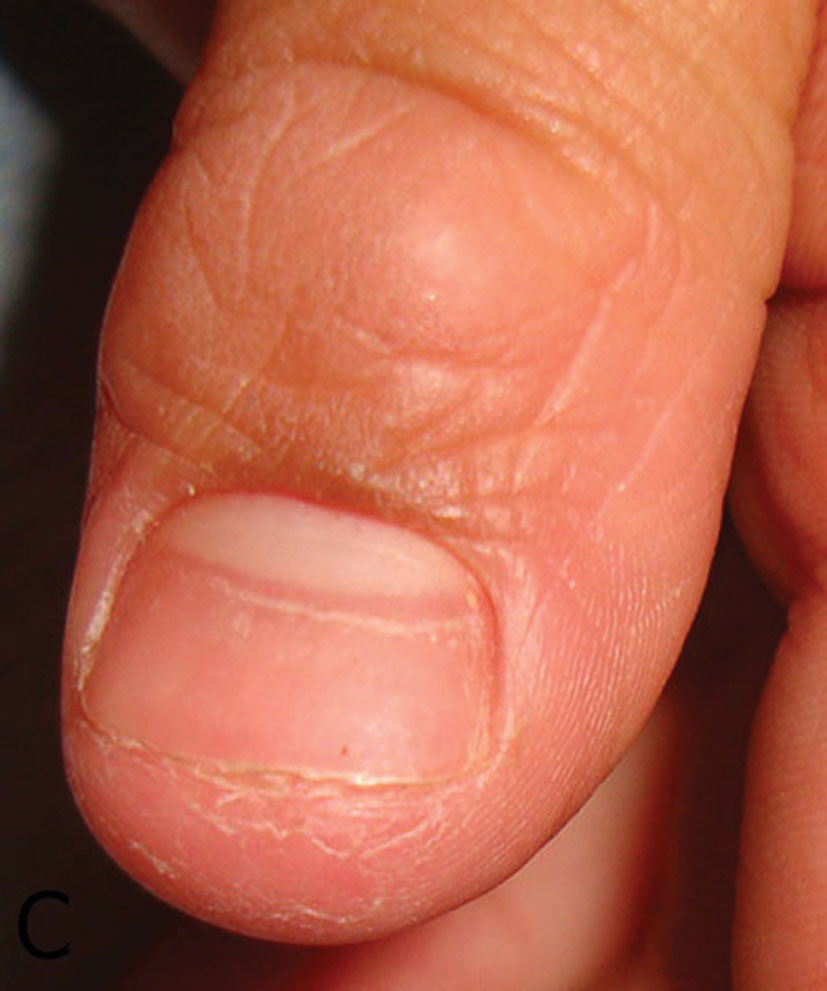 Nail Abnormalities: Clues to Systemic Disease - American ...