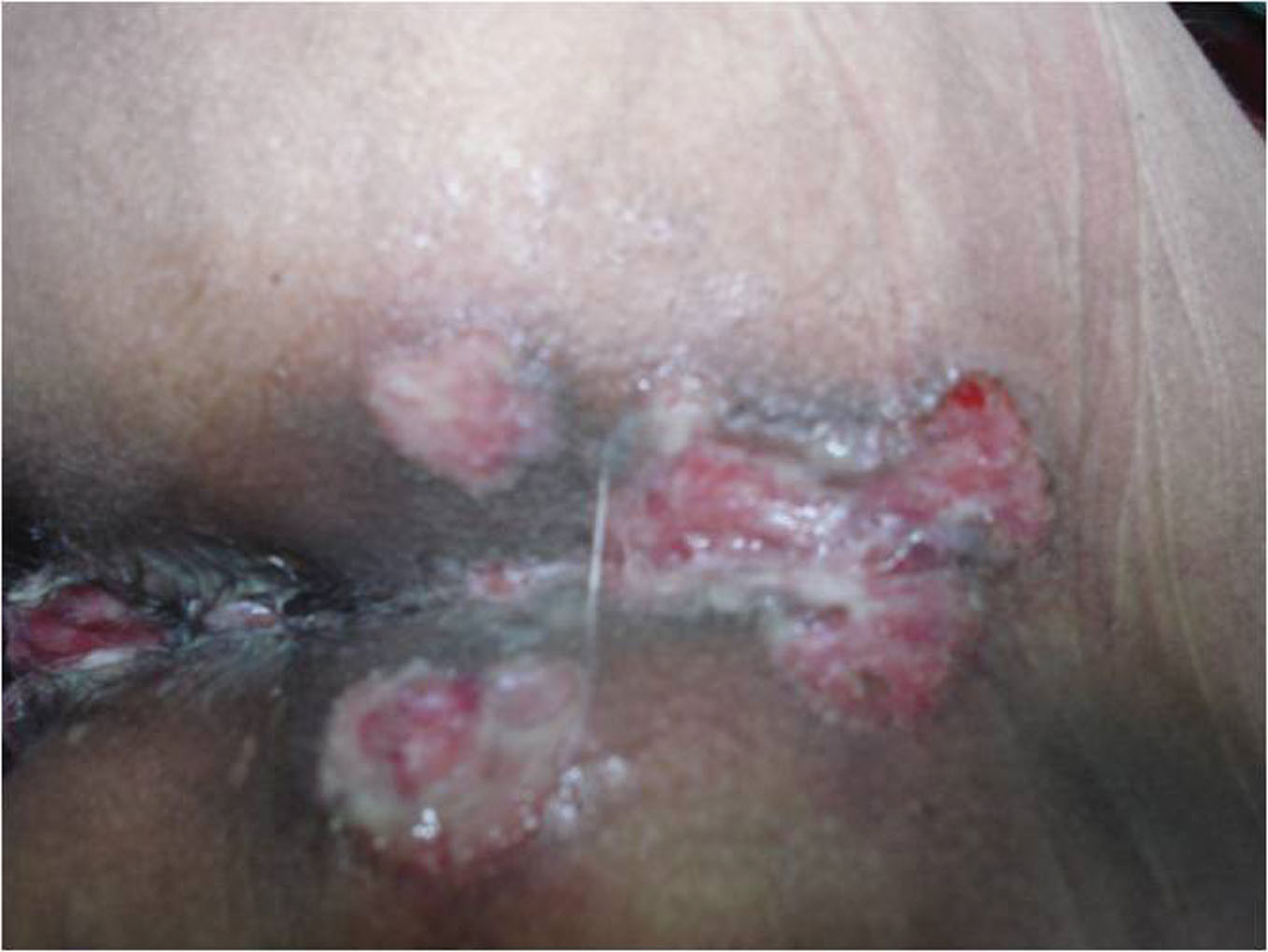 genital ulcer pictures