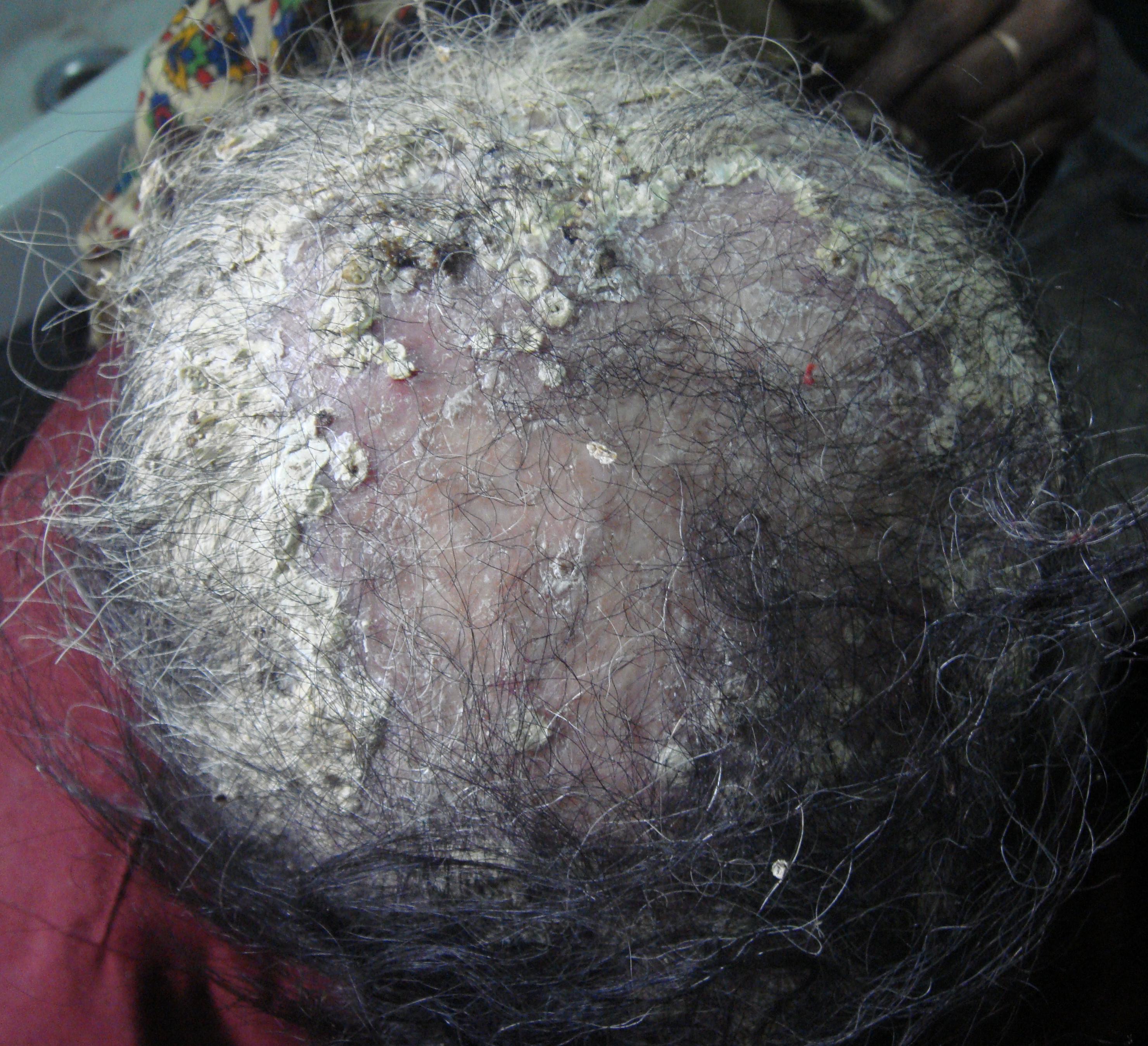 Бесцветные волосы при фавусе на волосистой части головы