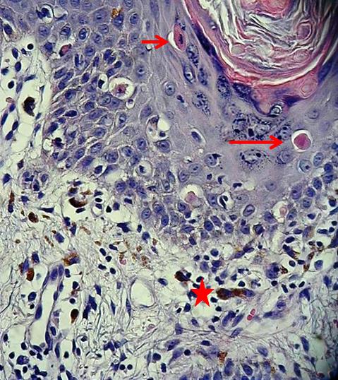 Lichenoide frictie dermatitis (frictional lichenoid ...