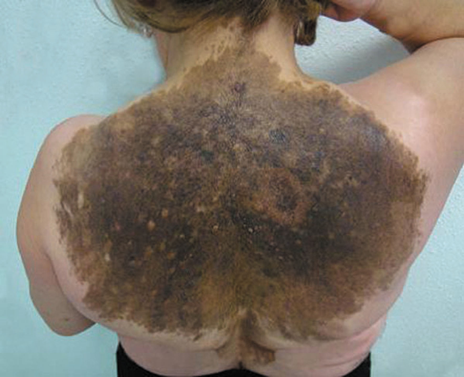 Melanoma and pigmented lesions - NICE CKS