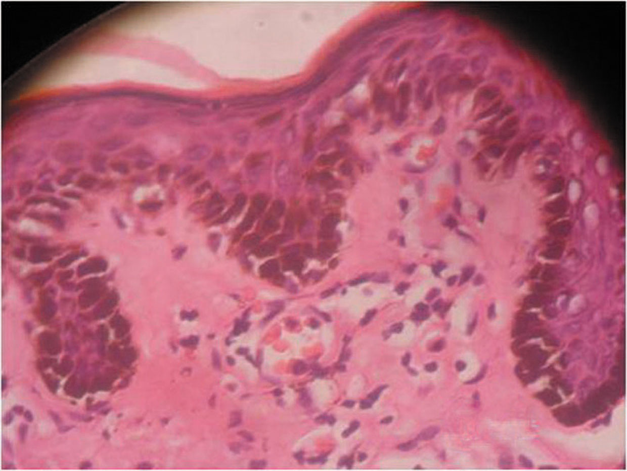 2012.2-5-Plasma cell | Our Dermatology Online journal