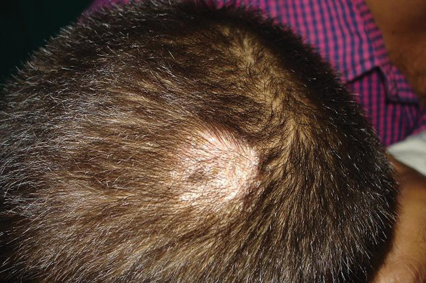 How to Treat Scalp Ringworm: 6 Steps (with Pictures ...