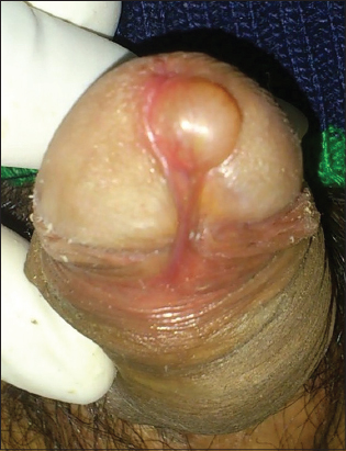 Large Penis Glans 35