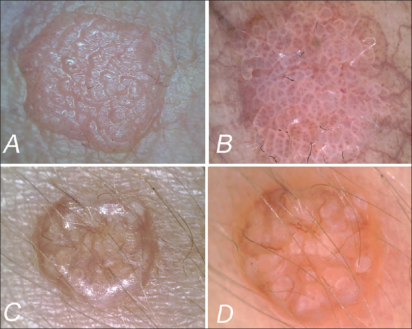 Condyloma acuminatum molluscum contagiosum