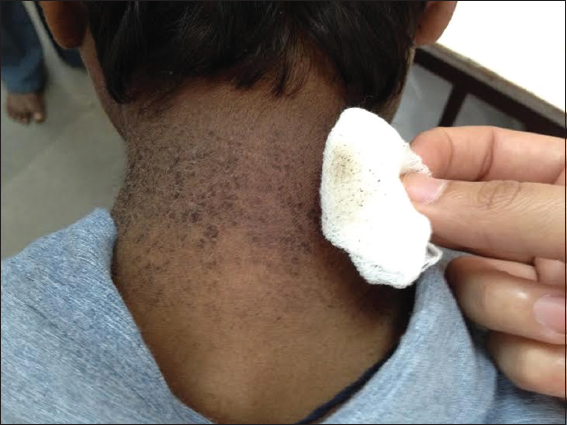 confluent and reticulated papillomatosis neck)