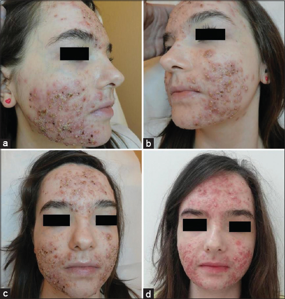 4 days acne azithromycin